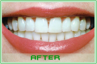 tooth-whitening-aftere
