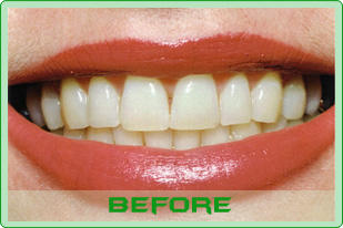 tooth-whitening-befor